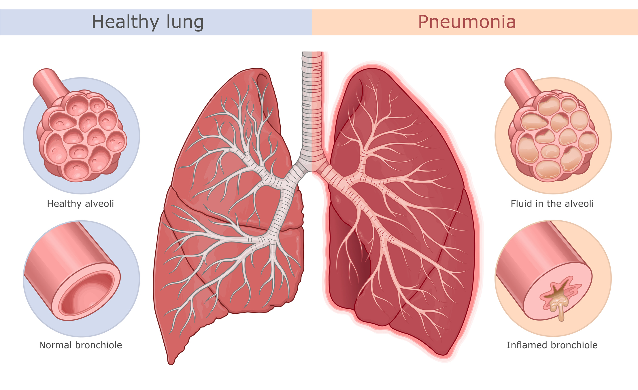 Diagram of a healthy lung next to a lung with pneumonia.